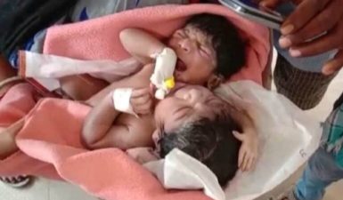 Ινδία: Μωρό γεννήθηκε με δύο κεφάλια και τρία χέρια