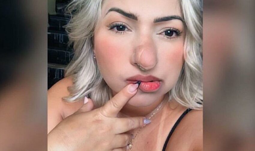Η γυναίκα… Πινόκιο: Διπλασιάστηκε η μύτη της μετά από μια σπάνια "ανωμαλία"